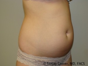 Liposuction Before and After 04 | Grover Aesthetics