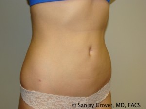 Liposuction Before and After 04 | Grover Aesthetics