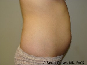 Liposuction Before and After 04 | Grover Aesthetics