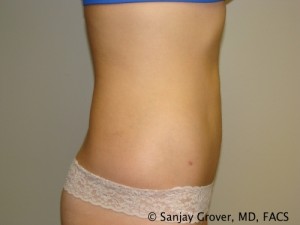 Liposuction Before and After 04 | Grover Aesthetics