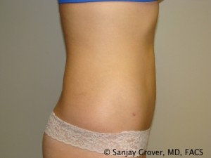 Liposuction Before and After 04 | Sanjay Grover MD FACS