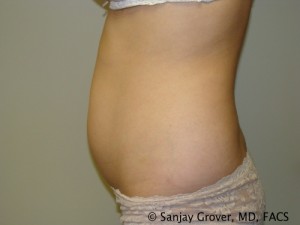 Liposuction Before and After 04 | Grover Aesthetics