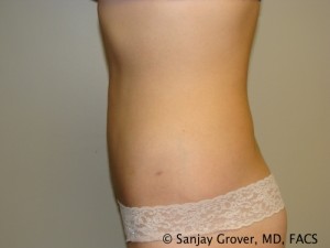 Liposuction Before and After 04 | Grover Aesthetics