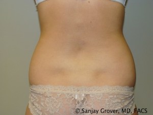 Liposuction Before and After 04 | Grover Aesthetics
