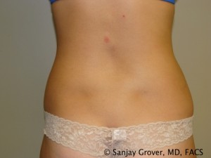 Liposuction Before and After 04 | Grover Aesthetics