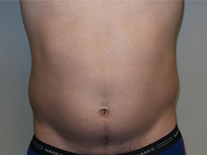 Liposuction Before and After 25 | Sanjay Grover MD FACS
