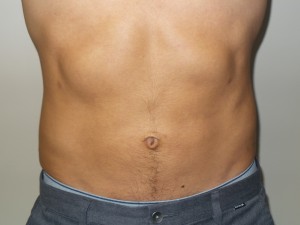 Liposuction Before and After | Grover Aesthetics