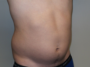 Liposuction Before and After 05 | Grover Aesthetics