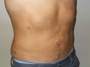 Liposuction Before and After 05 | Grover Aesthetics