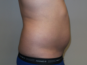 Liposuction Before and After 05 | Grover Aesthetics