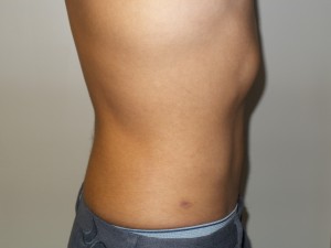 Liposuction Before and After 05 | Grover Aesthetics