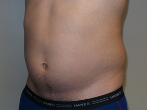 Liposuction Before and After 05 | Grover Aesthetics