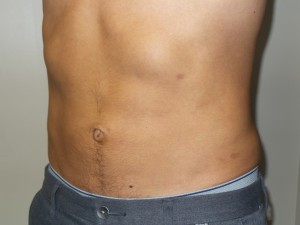 Liposuction Before and After 05 | Grover Aesthetics