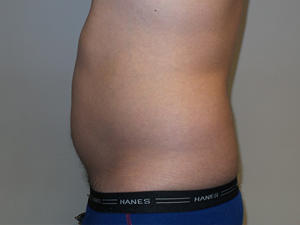 Liposuction Before and After 05 | Grover Aesthetics