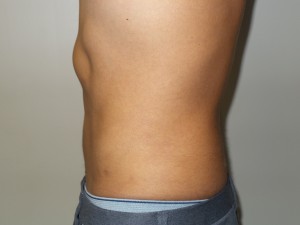 Liposuction Before and After 05 | Grover Aesthetics