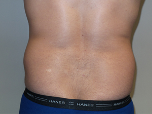Liposuction Before and After 05 | Grover Aesthetics