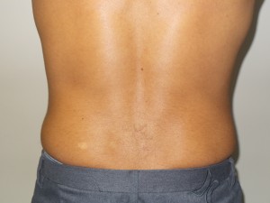 Liposuction Before and After 05 | Grover Aesthetics