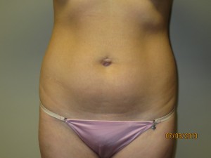 Liposuction Before and After 61 | Sanjay Grover MD FACS