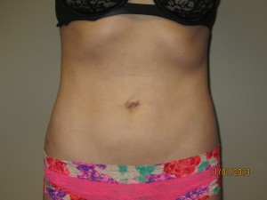 Liposuction Before and After | Grover Aesthetics