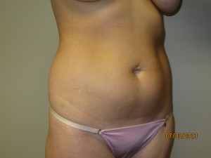 Liposuction Before and After 06 | Grover Aesthetics