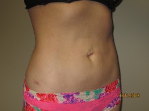 Liposuction Before and After 06 | Grover Aesthetics