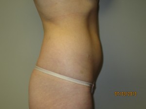 Liposuction Before and After 06 | Grover Aesthetics