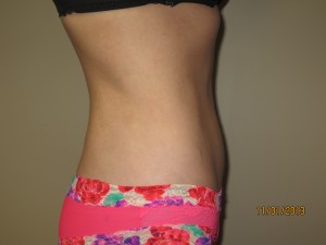 Liposuction Before and After 06 | Grover Aesthetics