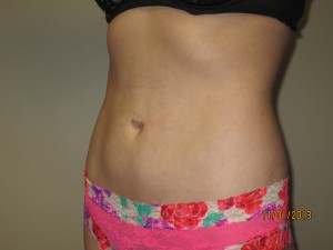 Liposuction Before and After 06 | Grover Aesthetics