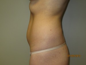 Liposuction Before and After 06 | Grover Aesthetics
