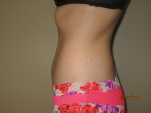 Liposuction Before and After 06 | Grover Aesthetics