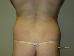 Liposuction Before and After 06 | Grover Aesthetics