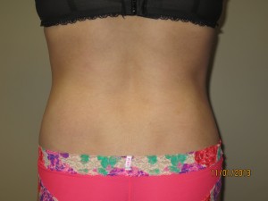 Liposuction Before and After 06 | Grover Aesthetics
