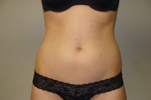 Liposuction Before and After | Grover Aesthetics