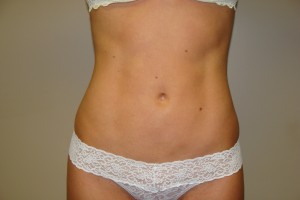 Liposuction Before and After | Grover Aesthetics