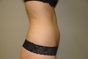 Liposuction Before and After 07 | Grover Aesthetics