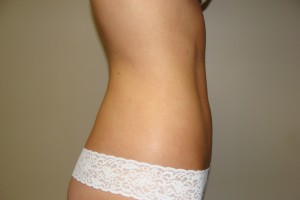 Liposuction Before and After 07 | Grover Aesthetics