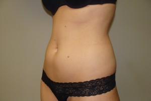 Liposuction Before and After 07 | Grover Aesthetics