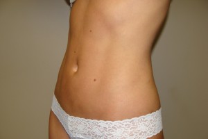 Liposuction Before and After 07 | Grover Aesthetics