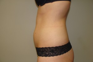 Liposuction Before and After 07 | Grover Aesthetics