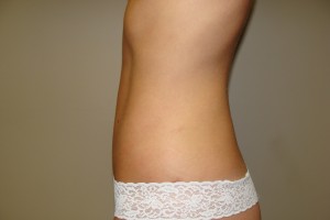 Liposuction Before and After 07 | Grover Aesthetics