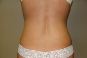Liposuction Before and After 07 | Grover Aesthetics