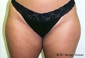 Liposuction Before and After | Grover Aesthetics