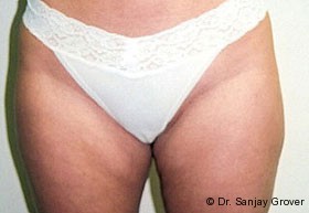 Liposuction Before and After | Grover Aesthetics