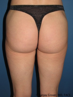 Liposuction Before and After | Grover Aesthetics