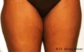 Liposuction Before and After 26 | Sanjay Grover MD FACS