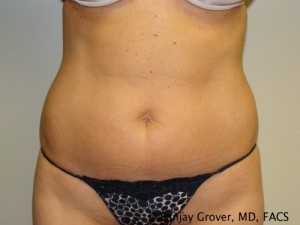 Liposuction Before and After 49 | Sanjay Grover MD FACS