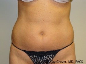 Liposuction Before and After 40 | Sanjay Grover MD FACS