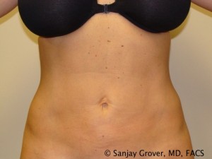 Liposuction Before and After 11 | Sanjay Grover MD FACS