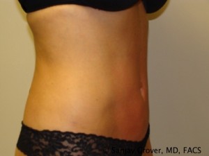 Liposuction Before and After 11 | Sanjay Grover MD FACS