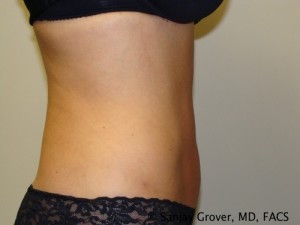 Liposuction Before and After 11 | Sanjay Grover MD FACS